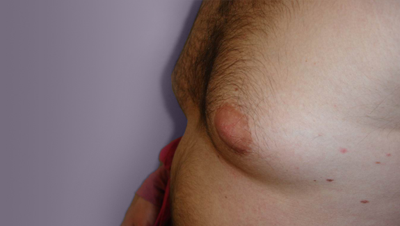 Gynecomastia - after 6 months